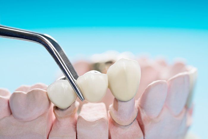 Dental bridge being held by tweezers over a plaster mold of teeth, against a blue background.